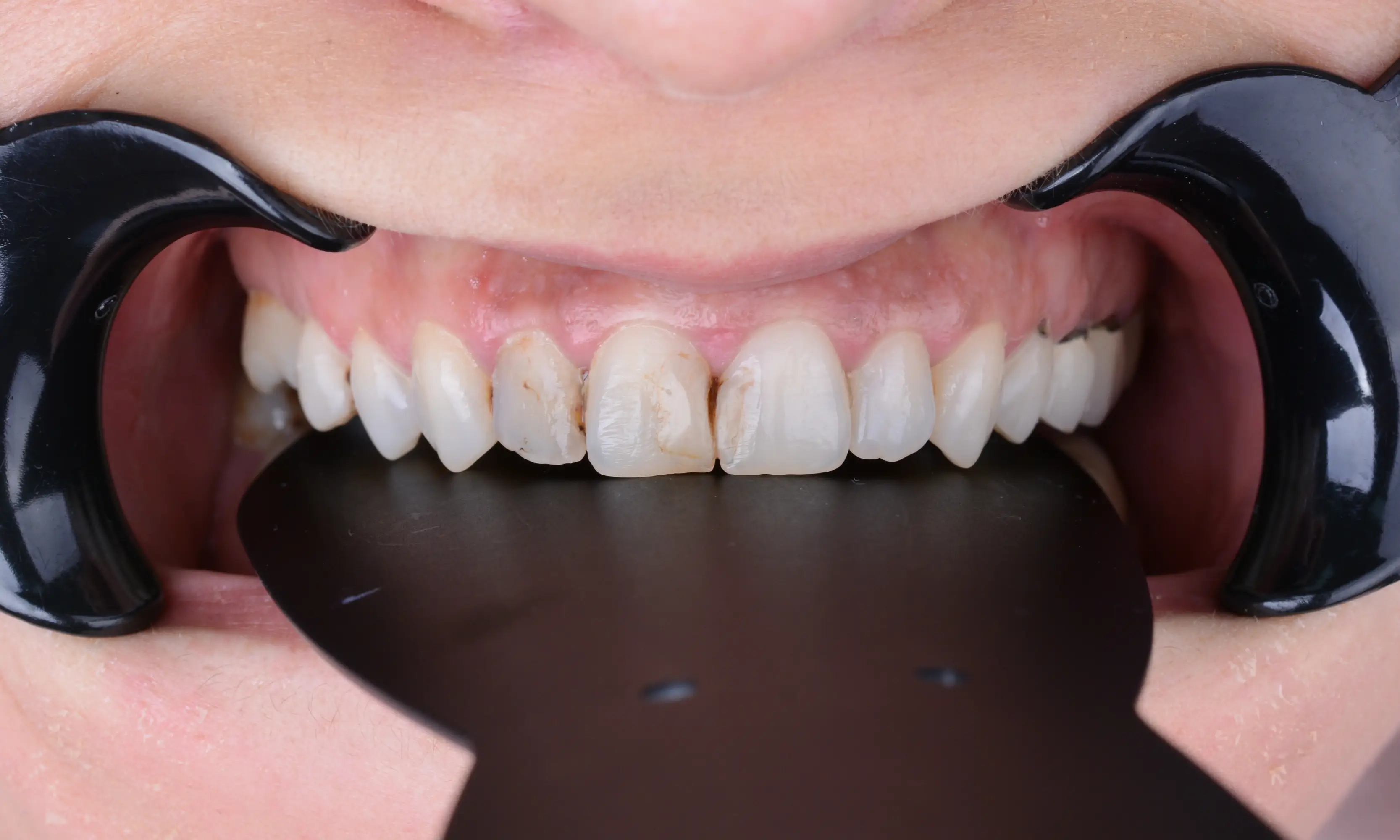 Tam Zirkonyum Öncesi - Vaka 62 - Milim Dental Hospital Bursa