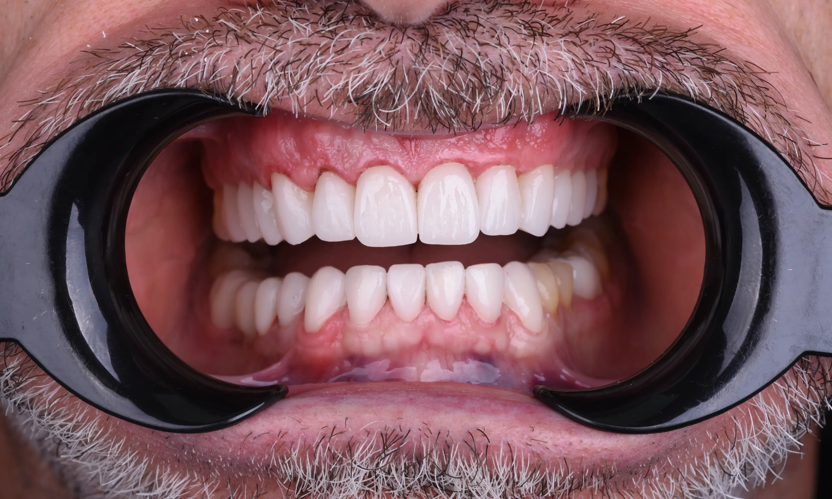 Tam Zirkonyum Sonrası - Vaka 65 - Milim Dental Hospital Bursa