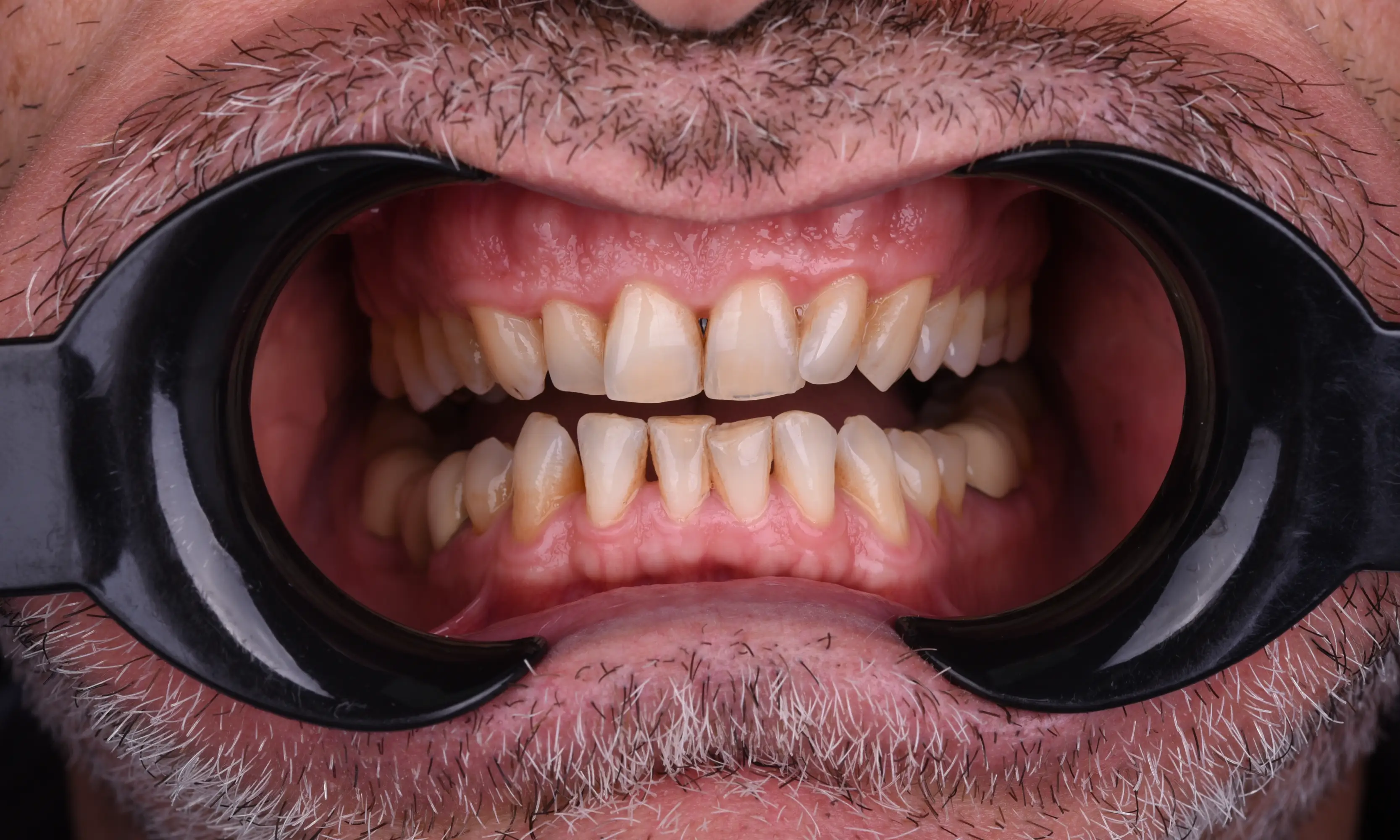Tam Zirkonyum Öncesi - Vaka 65 - Milim Dental Hospital Bursa